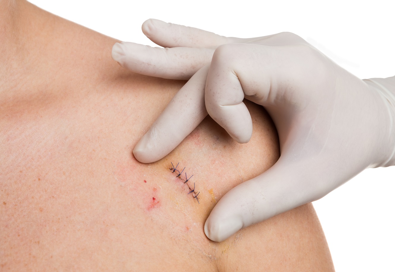 Retrait des sutures – s/groupe-effiscience–infirmier/sg/profilesuture.jpg